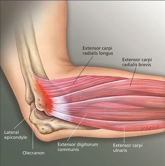 What is Tennis Elbow (Lateral Epicondylalgia)?