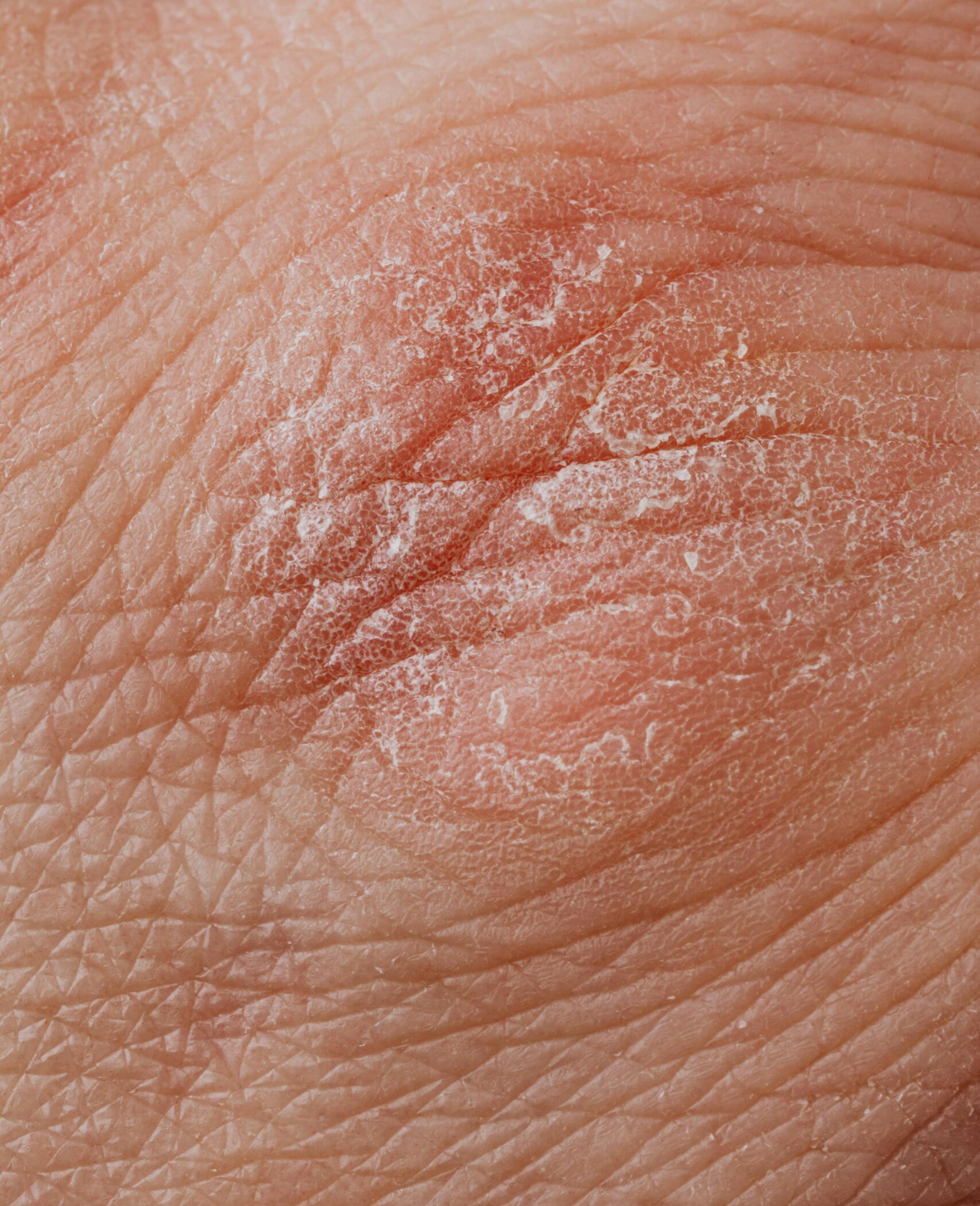 A close-up of dry, cracked skin, indicating the need for deep tissue massage techniques like trigger point therapy to release tension and improve circulation.